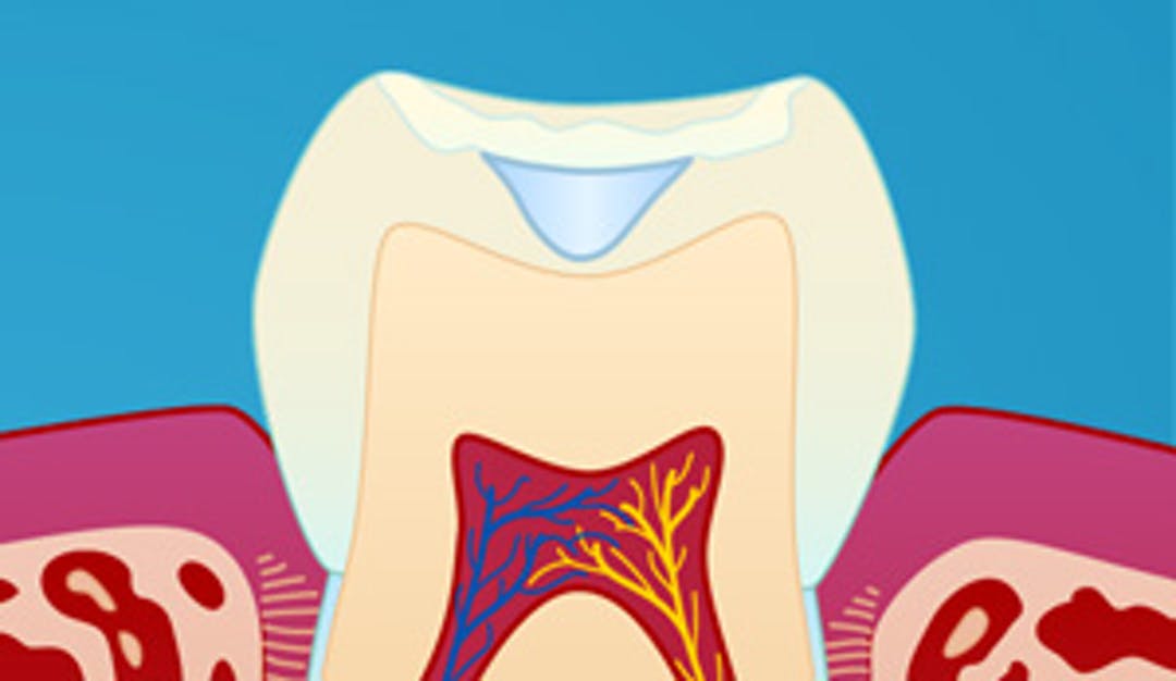 Fissurforsegling_w300__574c0a02f55af7ced75bd1697002b7b1