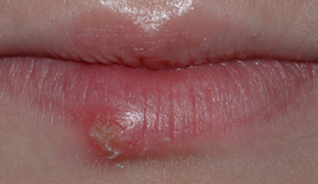 Herpes_munnsar_w300__114820c0237ed1e590af96c5dea21e15