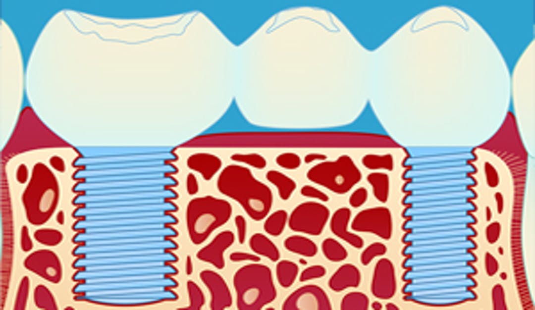 Implantat_bro_thumbnail_w300__c9b7d1f31d7445ddbc5a491aa8dfb85f