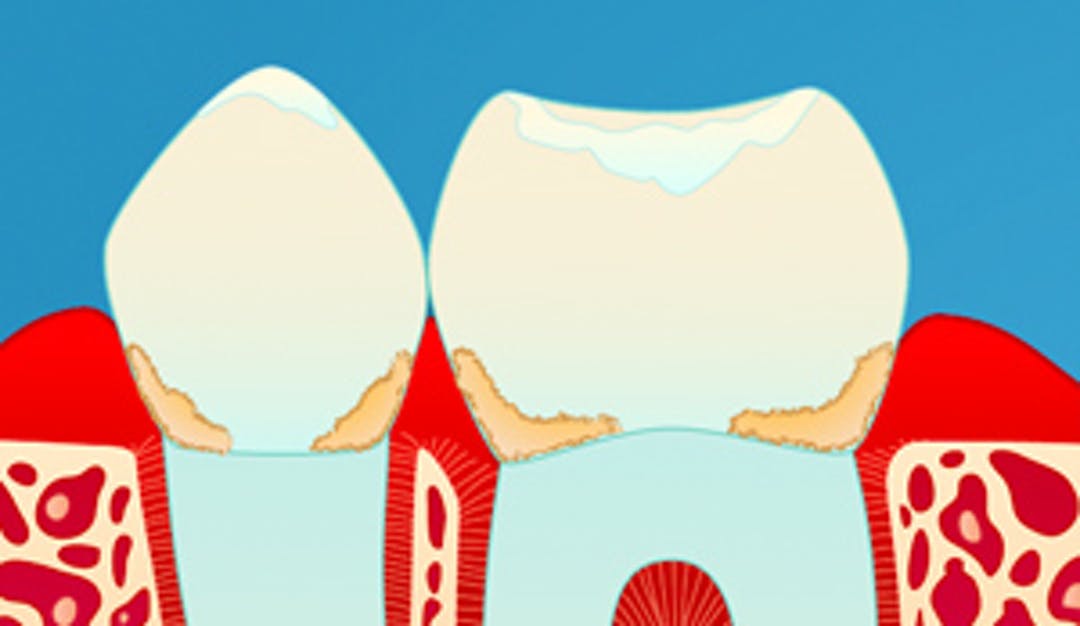 gingivitt_w300__0efa8298b53c4c1e45accc65c2aa437f-1